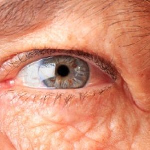 بیماری ماکولا شبکیه چشم